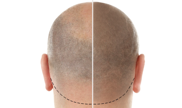 Resurgens Studio Luxembourg | Micro-pigmentation | Effet rasé Homme