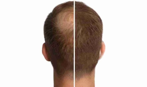 Resurgens Studio Luxembourg | Micro-pigmentation | Densification Homme