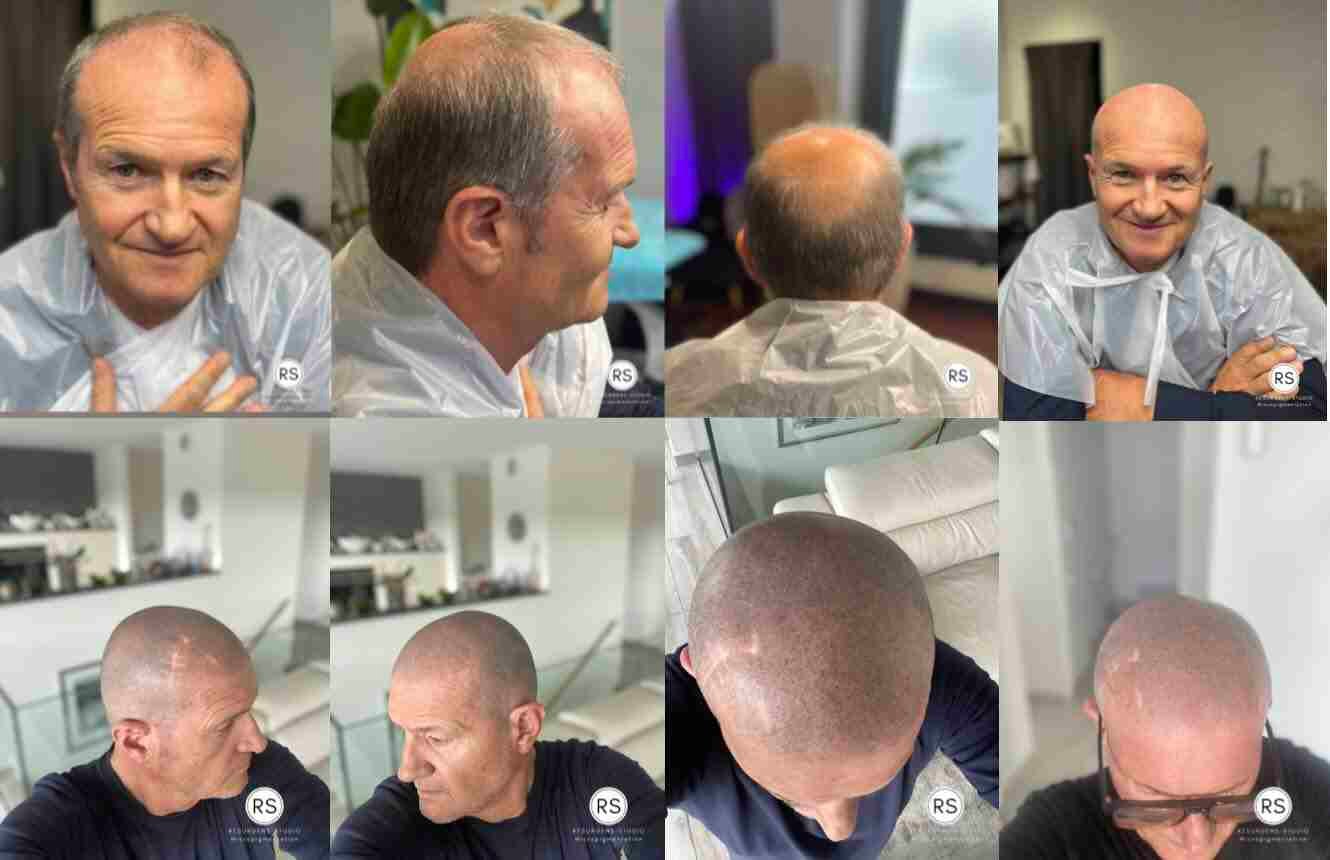 Resurgens Studio Luxembourg | Micro-pigmentation effet rasé