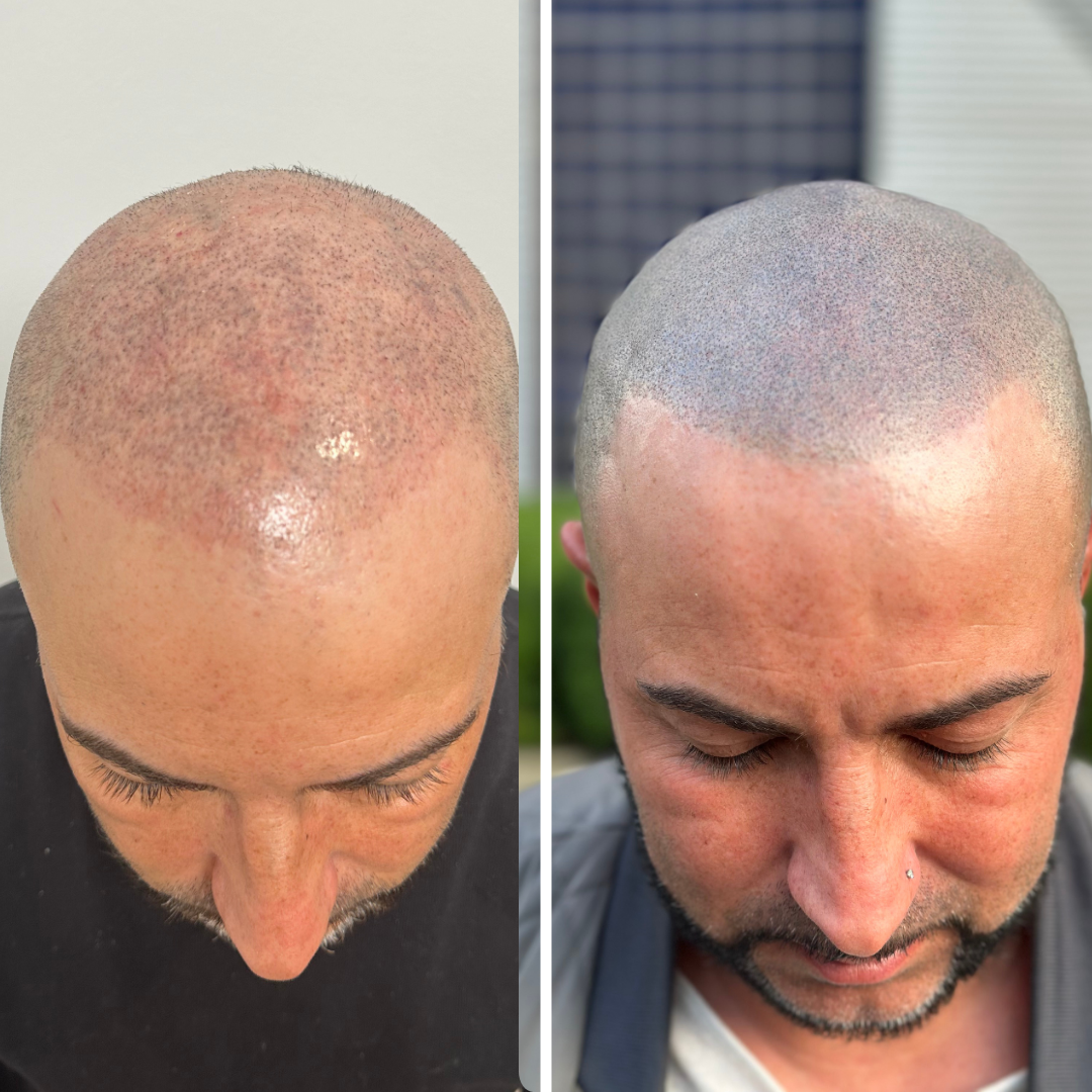 Resurgens Studio Luxembourg | Micro-pigmentation effet rasé
