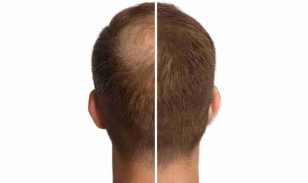 Resurgens Studio Luxembourg | Micro-pigmentation | Densification Homme